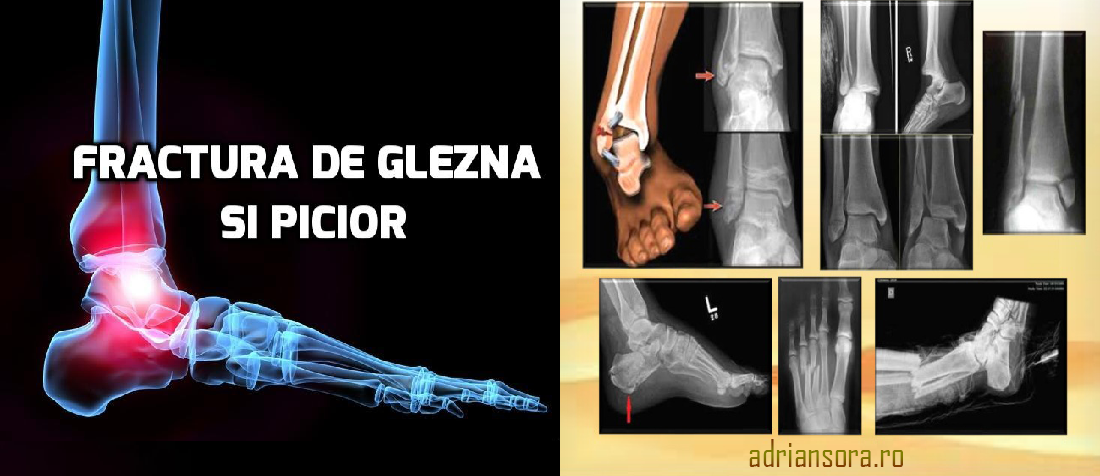 tratamentul fracturilor de gleznă artrita genunchiului